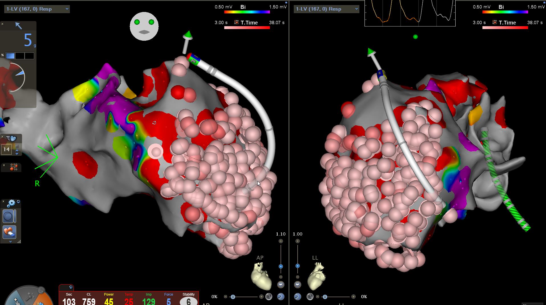Digitale Visualisierung Kammerrhythmusstörungen